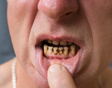 methamphetamine effects on teeth