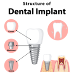 Dental Implants Ohio