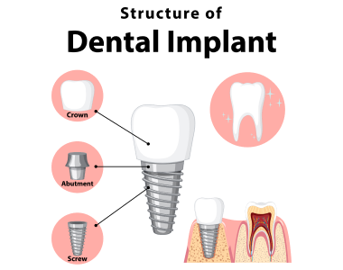 Dental Implants Ohio
