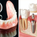 advantages-of-dental-implants-over-dentures